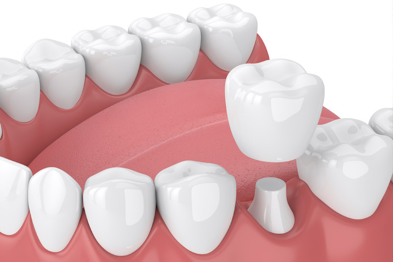 Dental Crowns in Gastonia