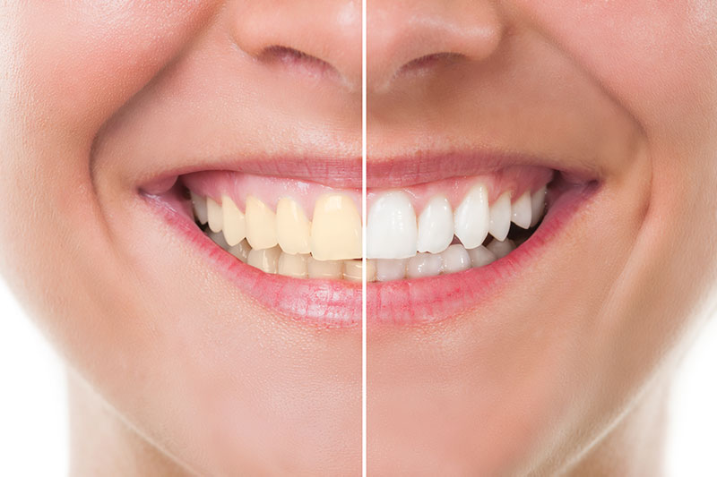 Teeth Whitening in Gastonia