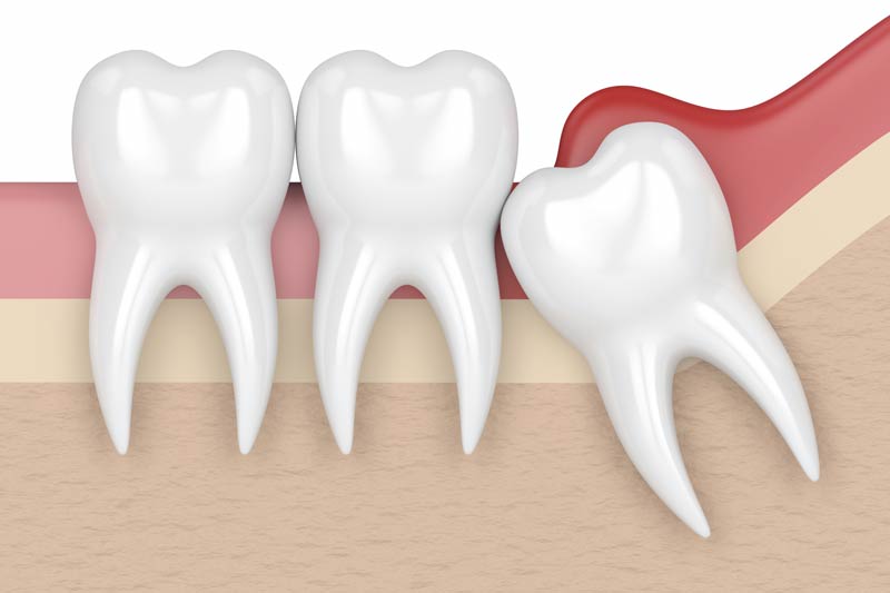 Wisdom Tooth Removal in Gastonia